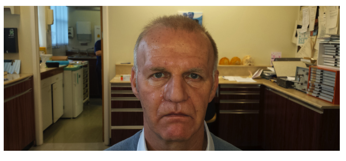 Can you see this man’s facial prosthesis? The color is so perfectly matched that it looks completely natural.